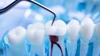 Model of inflamed root in row of teeth